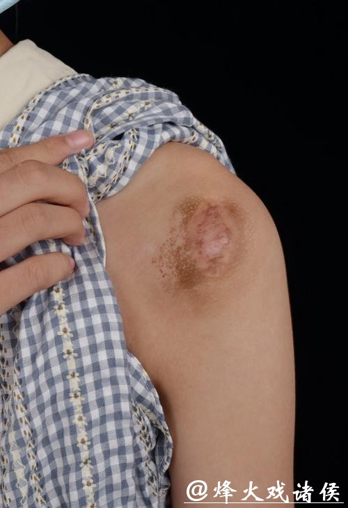 有没有人这个位置长瘢痕疙瘩？